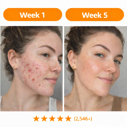 Sea Buckthorn Acne Balm